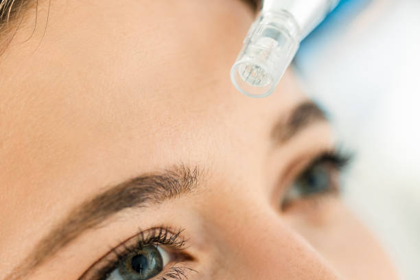 When to Exercise After Microneedling: Optimal Timing for Post-Treatment Workouts