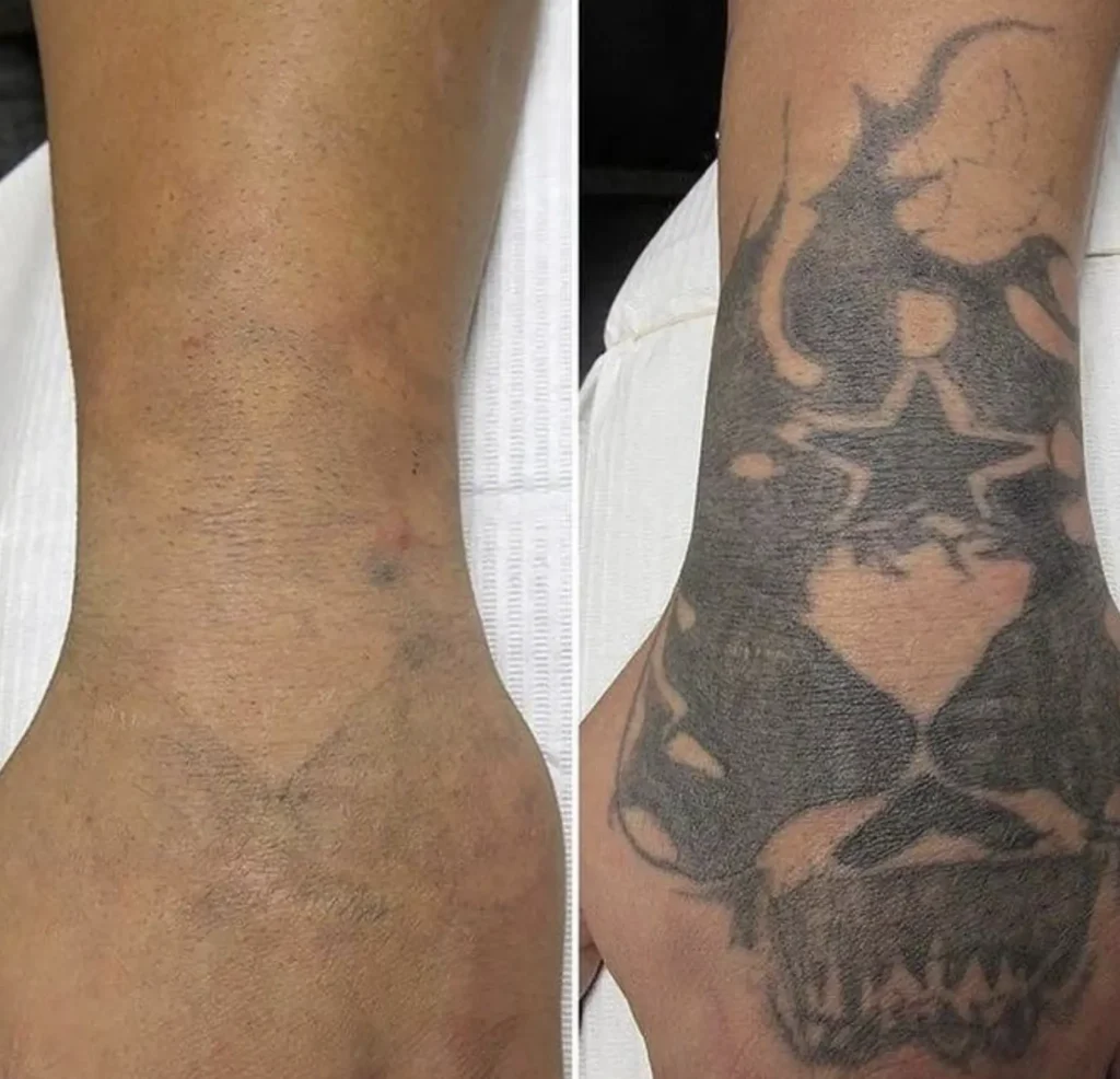 lazer tattoo removal