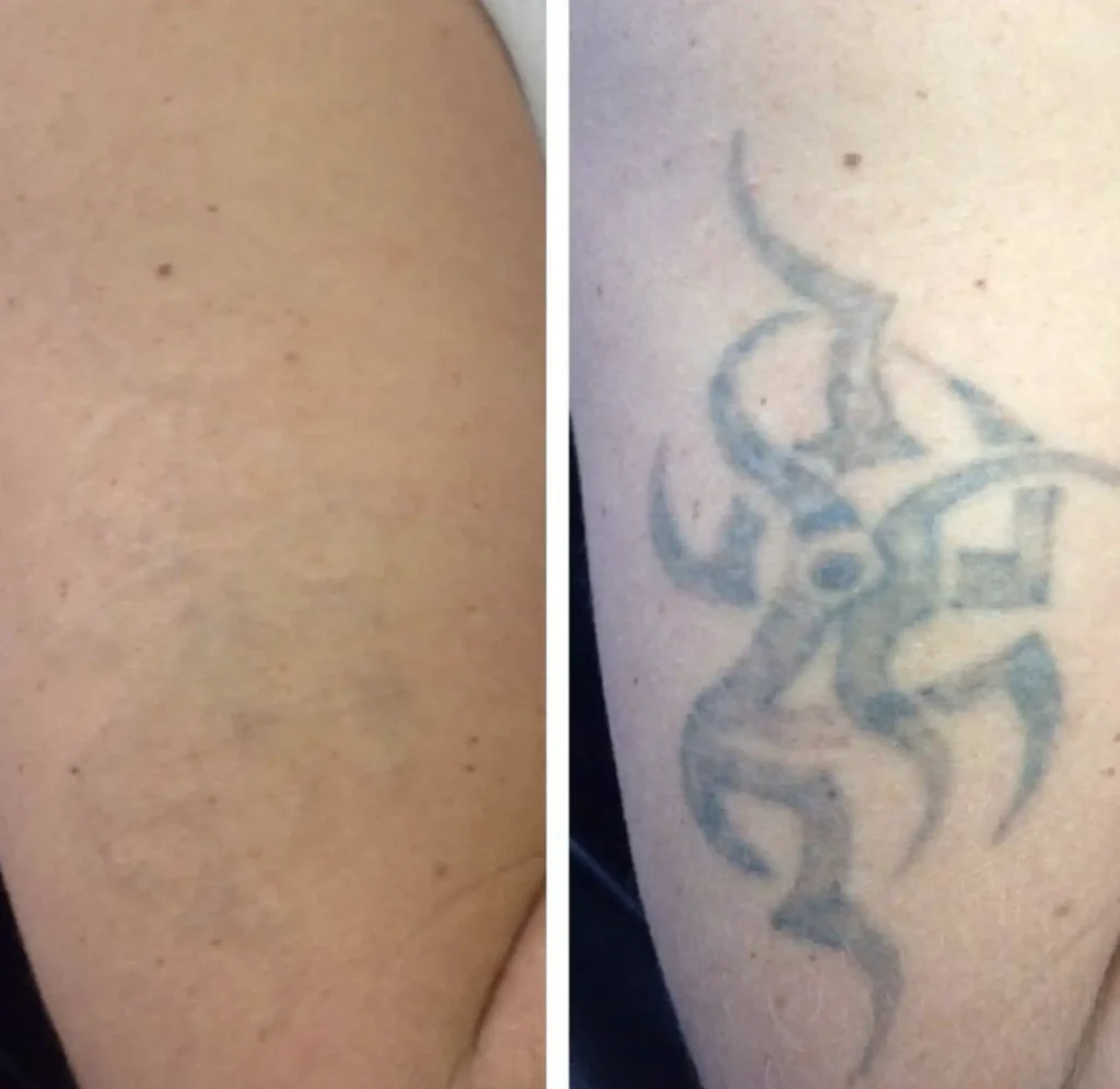 tattoo removal melbourne