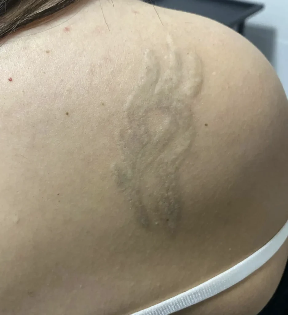 tattoo removal specialist melbourne