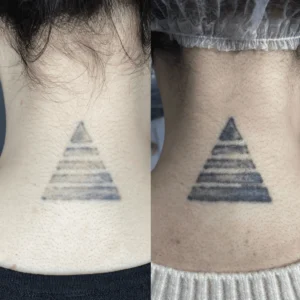 what is tattoo removal