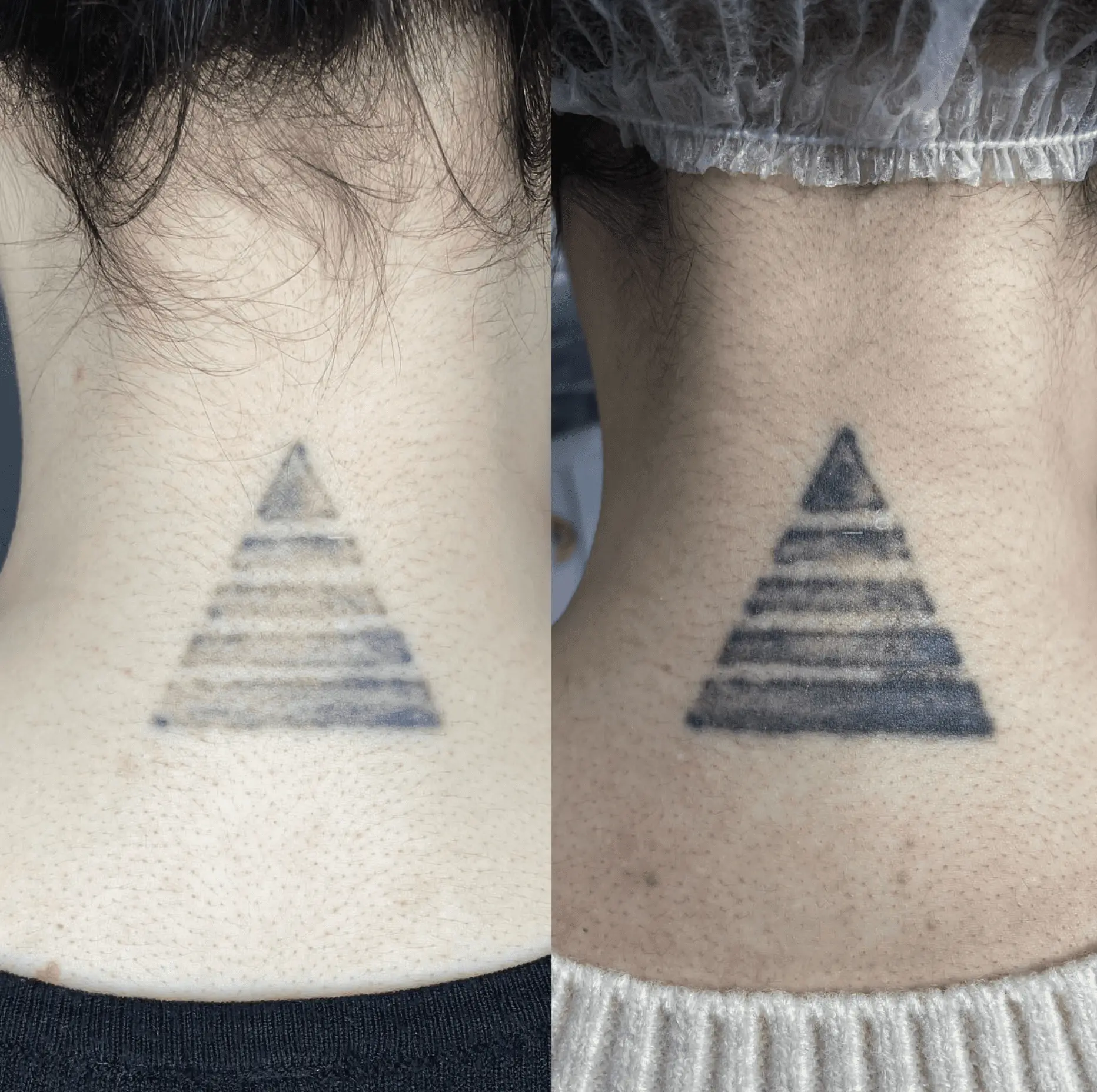 what is tattoo removal